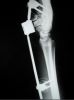 Fratture post-operatorio